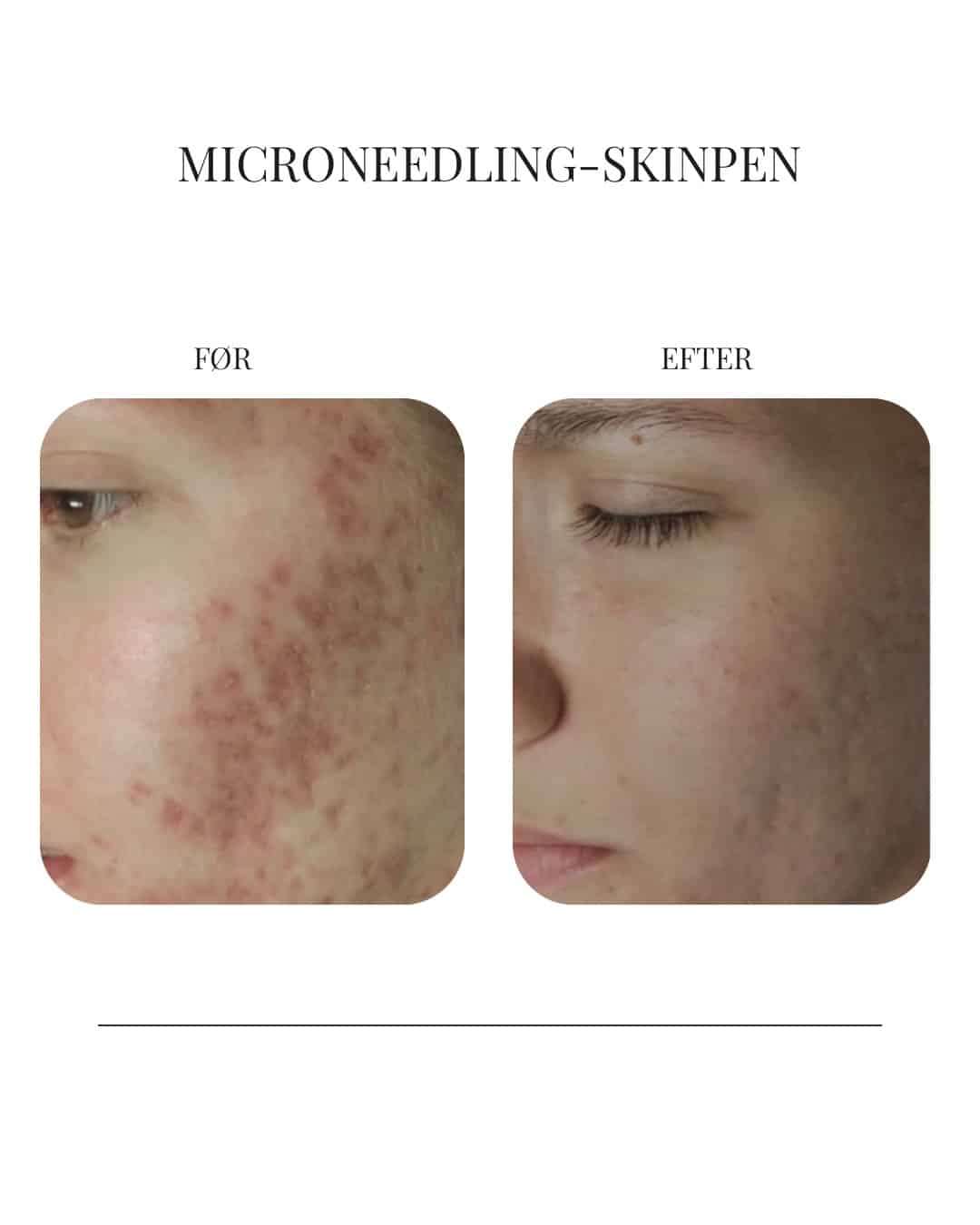 Før og efter SkinPen Microneedling